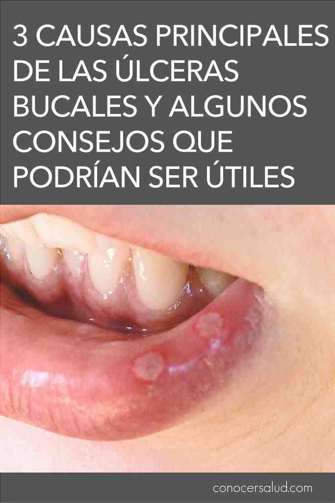 tipos sintomas causass ulceras bucales pinterest
