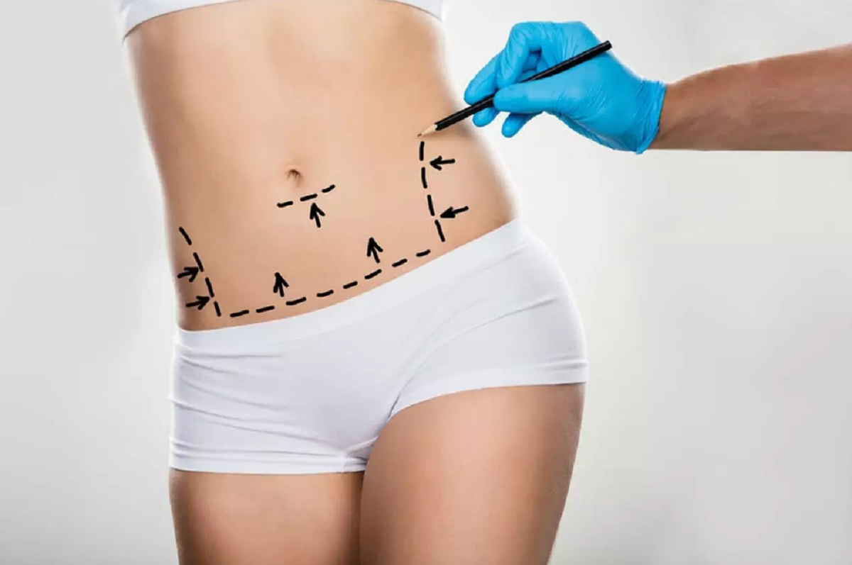 Como é fazer uma abdominoplastia?